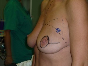 mastectomia-ahorradora-de-piel-para-reconstruccion-inmediata-clinica-morales-02